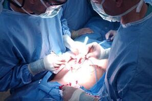 Durchführen einer Operation, um den Penis zu erhöhen