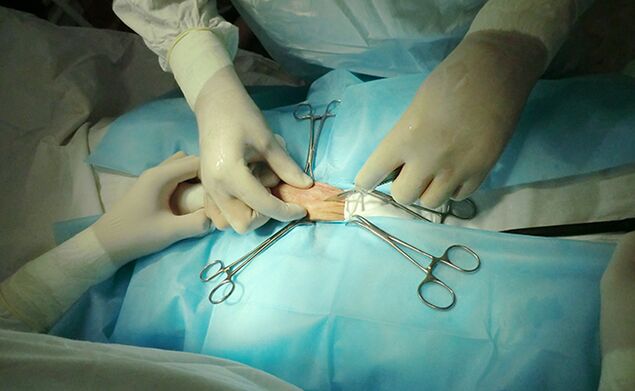 Eine Operation am Fortpflanzungsorgan kann dazu beitragen, dessen Größe zu vergrößern