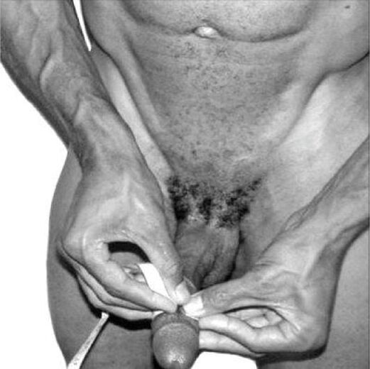 Penisvermessung vor der Vergrößerung