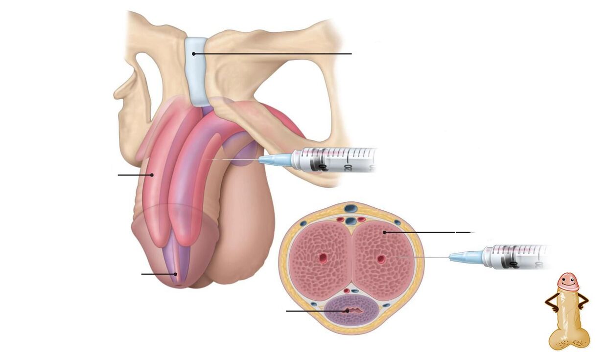 Hyaluronsäure-Injektionen zur Penisvergrößerung